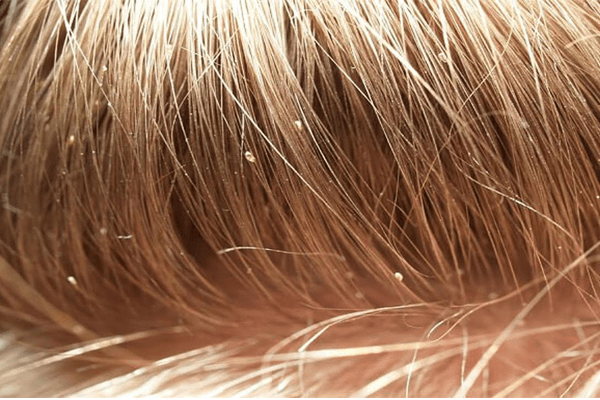 18 Natural Remedies To Get Rid Of Head Lice