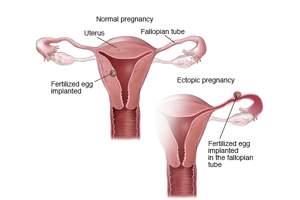 Ectopic Pregnancy 