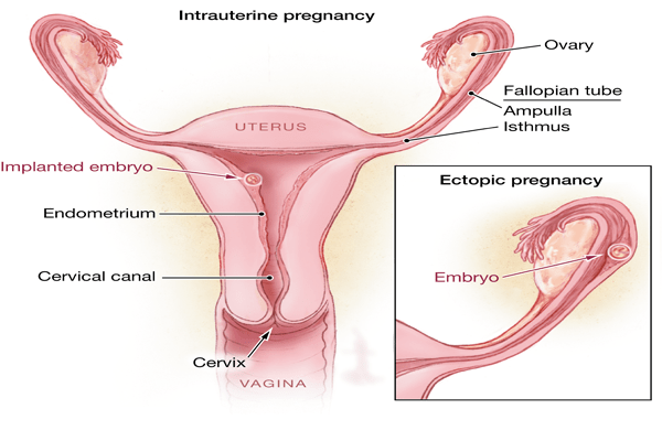 Ectopic Pregnancy | Symptoms, Causes, Prevention and Treatments