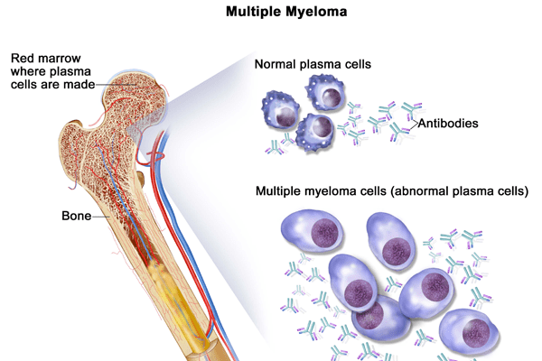 Multiple Myeloma