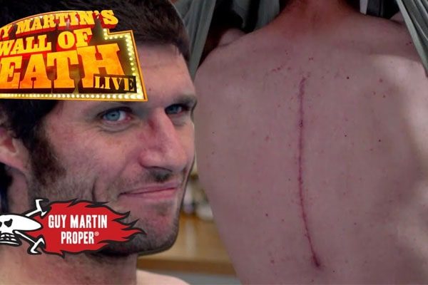 Guy Martin's fractures