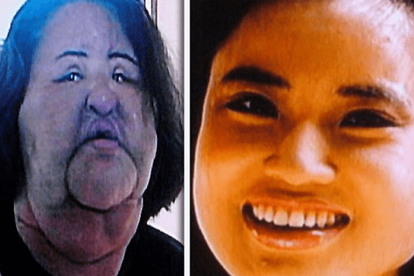 Is Hang Mioku Still Alive or Dead? Korean Who Injected Cooking Oil in Her Face