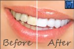 Is teeth Whitening method healthy