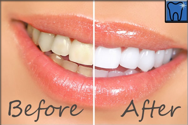How good are the Teeth Whitening Methods?