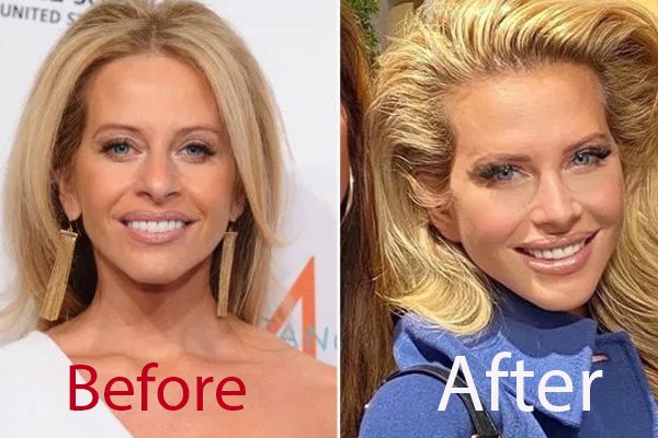 Dina Manzo's surgery