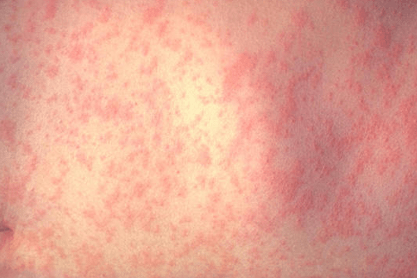 37 Amazing Natural Remedies To Cure Measles