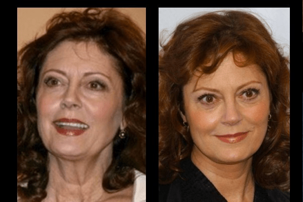 Susan Sarandon before and after cosmetic surgery