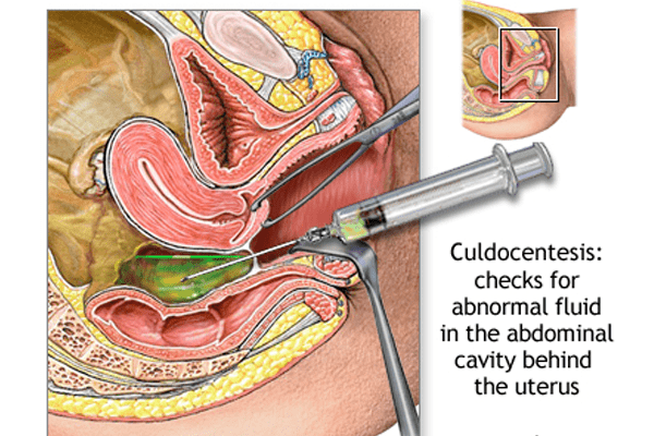  Culdocentesis Ectopic Pregnancy