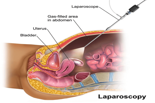 Laparoscopy Ectopic Pregnancy