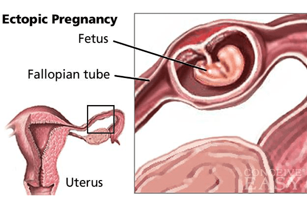 Ectopic Pregnancy