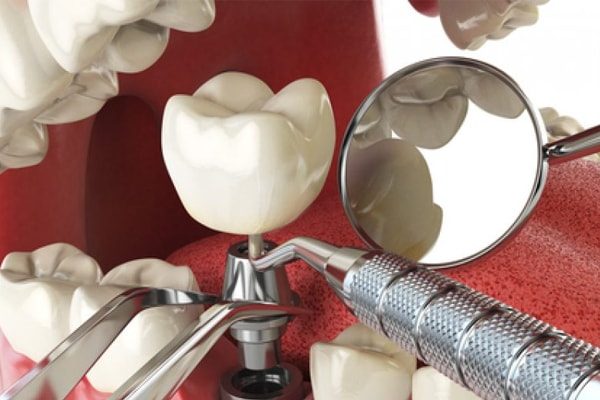 Why dental implants?