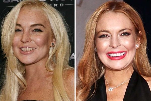 Lindsay Lohan's teeth
