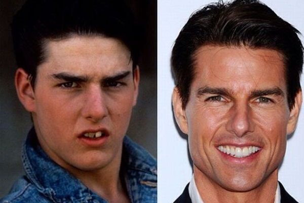 Tom Cruise teeth then and now